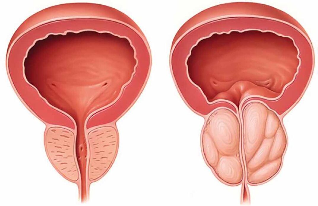 Normali prostata ir priešinės liaukos uždegimas (lėtinis prostatitas)