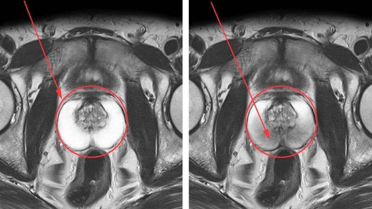 Lėtinio prostatito ultragarsas – sveika prostata (kairėje) ir uždegimas (dešinėje)