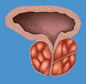 Būdingi prostatito požymiai