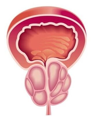 Vyrų prostatito simptomai