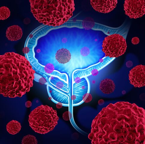 Patogeninių mikroorganizmų veikla yra prostatito vystymosi priežastis