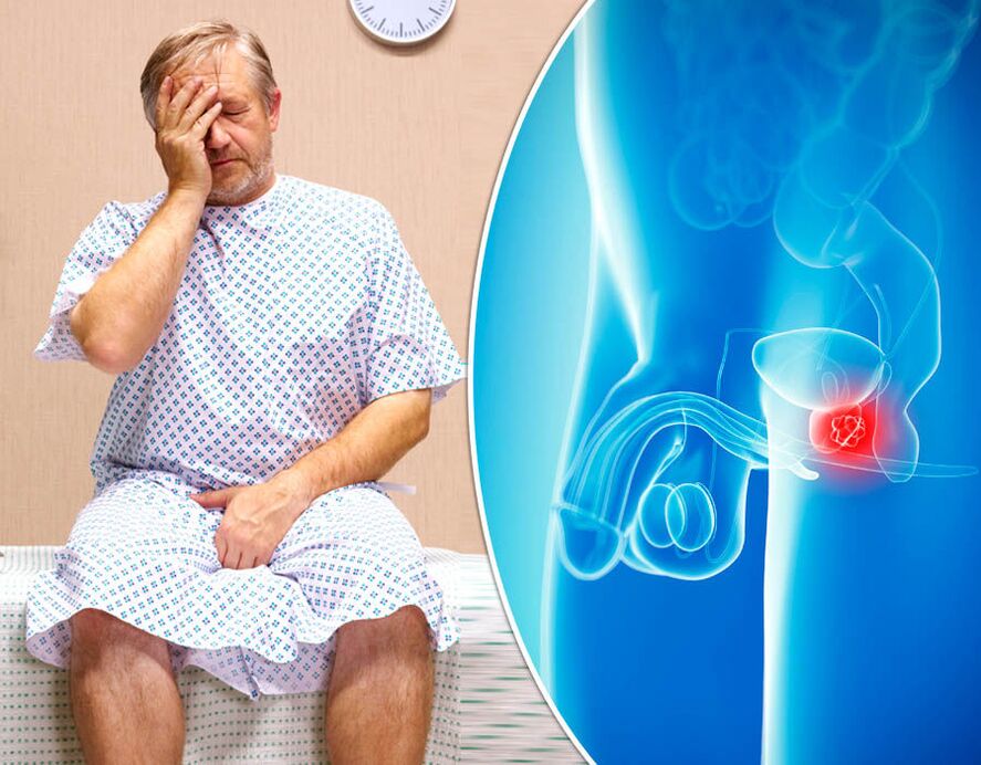 Prostatitu sergančiam vyrui diagnozuojama liga