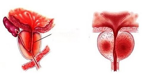 Kaip atrodo lėtinis prostatitas